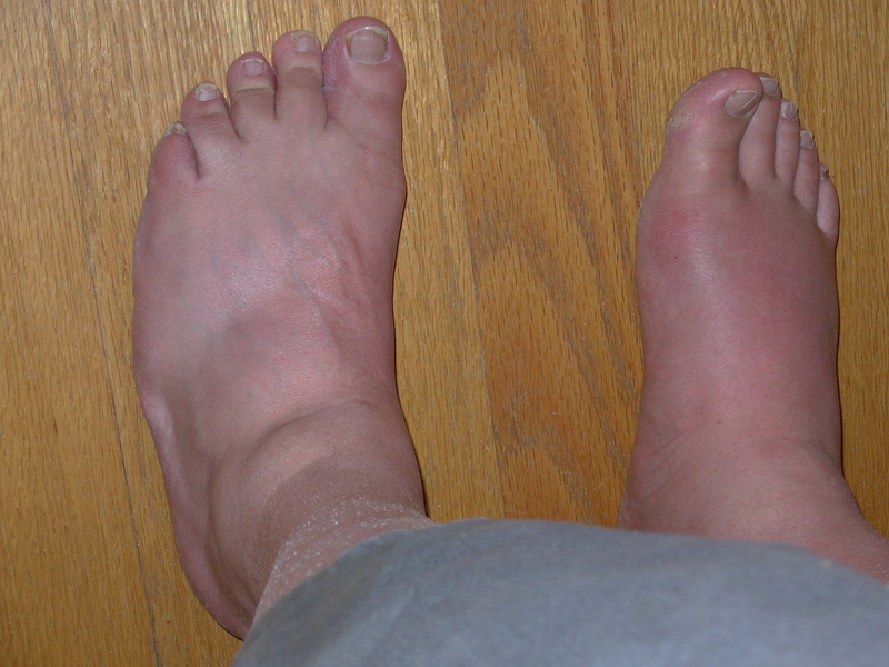 Illustration for article titled Gout and Ayurveda treatment in Nagpur